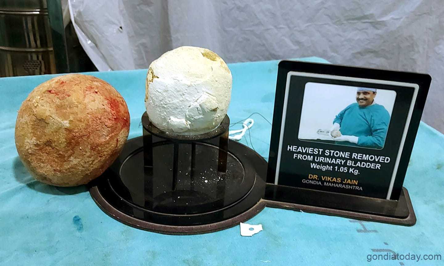 डॉ विकास जैन यांनी महिला रूग्णाच्या मूत्राशयातून 167 किलोचे
